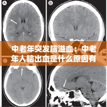 中老年突发脑溢血：中老年人脑出血是什么原因有哪些 