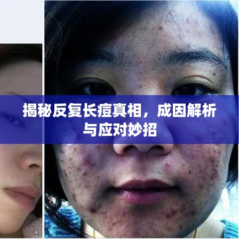 揭秘反复长痘真相，成因解析与应对妙招