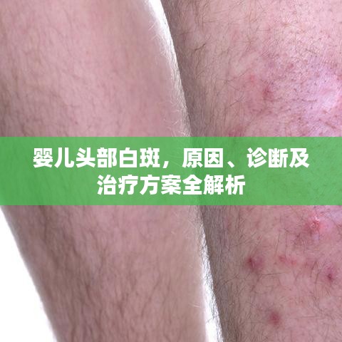 婴儿头部白斑，原因、诊断及治疗方案全解析